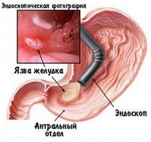 ФГС желудка (фиброгастроскопия): как делается?