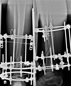 Рентген ноги: фото снимков, что видно?