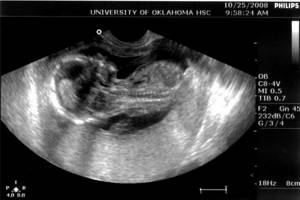 Фото УЗИ размера плода на 15 неделе беременности