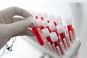 Анализ крови при раке: можно ли определить?