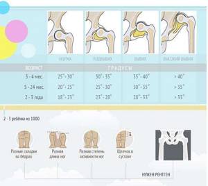 УЗИ тазобедренных суставов у грудничков: норма углов, расшифровка