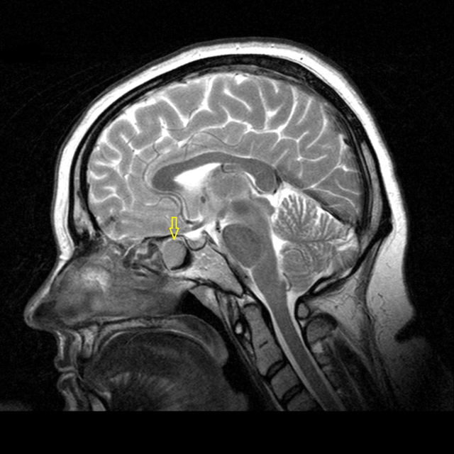 Что показывает МРТ головного мозга: расшифровка результатов
