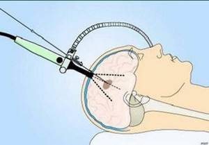 Биопсия мозга: особенности проведения процедуры