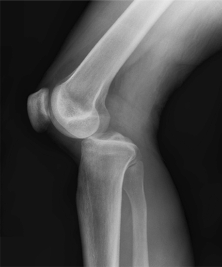 Рентген коленного сустава: что показывает, как выглядит здоровый сустав?