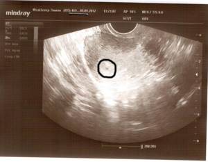 УЗИ на 3 недели беременности: фото, что видно?