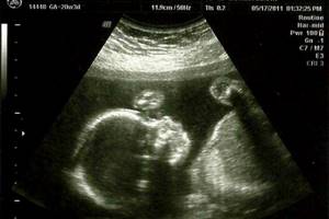 УЗИ на 20 неделе беременности: фото, показатели, нормы