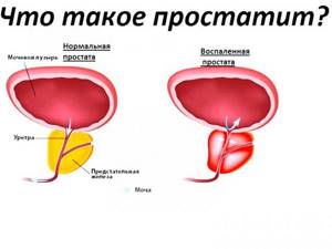 Эритроциты в моче у мужчин: норма, причины повышения