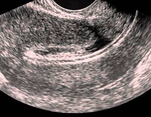 Норма размеров матки по УЗИ при беременности и после родов