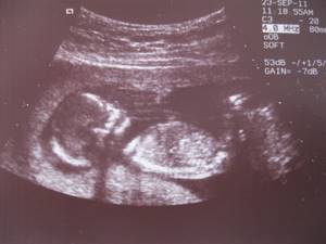 Фото размера плода на УЗИ на 14 неделе беременности