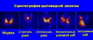 Сцинтиграфия щитовидной железы: как проводят, побочные эффекты, подготовка