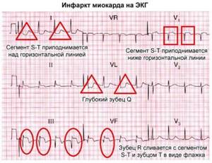ЭКГ при инфаркте миокарда: признаки, фото, расшифровка