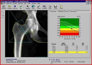 Рентгеновская денситометрия: для чего и как ее делают?
