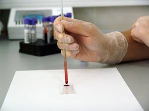 Что такое АСТ в биохимическом анализе крови?