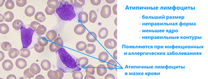 Атипичные лимфоциты в анализе крови: что это такое и почему появляются?