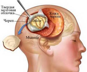 Биопсия мозга: особенности проведения процедуры