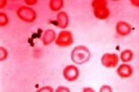 Гипохромия в общем анализе крови – что это?