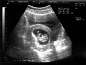 УЗИ беременности на ранних сроках: вредно ли, как делают?