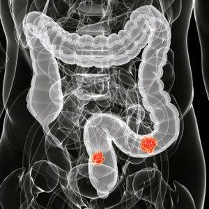 Рентген кишечника: как делают и что показывает?