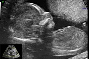 УЗИ на 17 неделе беременности: фото, показатели