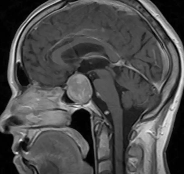 МРТ с контрастом: головного мозга, гипофиза, малого таза