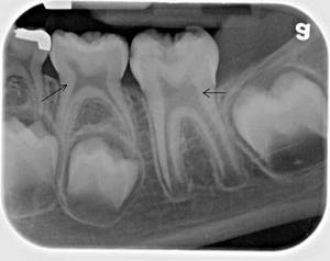 Рентген зубов: как делают и как часто можно? (с фото)