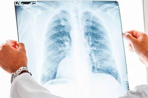 Рентген грудной клетки: что показывает, как часто делать?