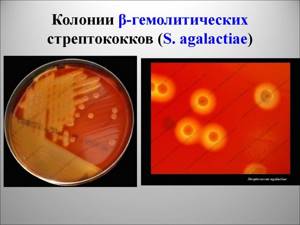 Стрептококк агалактия в мазке: лечение, причины появления