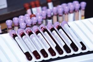 Общий анализ крови при онкологии – показывает ли рак?