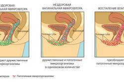 Биопсия шейки матки: как проводится, результаты, подготовка к процедуре