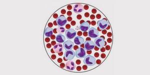Норма лейкоцитов в крови и причины отклонения