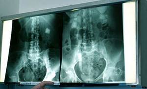 Рентген желудка с барием: подготовка, последствия, что показывает?
