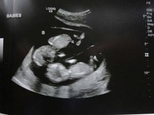 Фото многоплодной беременности на УЗИ: когда видно?