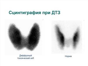 Сцинтиграфия щитовидной железы: как проводят, побочные эффекты, подготовка