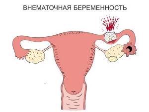 Внематочная беременность на УЗИ: фото, можно ли увидеть ее?