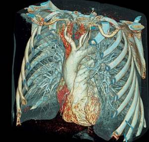 Компьютерная томография (КТ) грудной клетки и органов – что показывает?