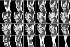 МРТ коленного сустава: что показывает и как проходит обследование?
