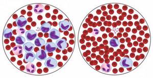 Повышенные лимфоциты в крови у женщин: причины, о чем это говорит?