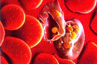 Гемолиз эритроцитов: причины, признаки, виды, лечение