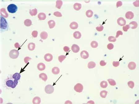 Микроцитоз в общем анализе крови – что это?