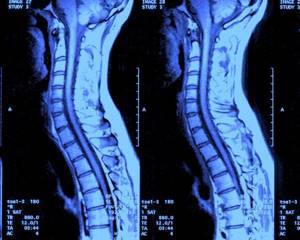 МРТ спины – что показывает?