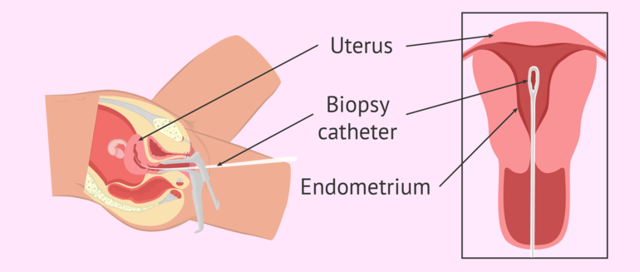 Выделения после биопсии шейки матки: норма или патология?