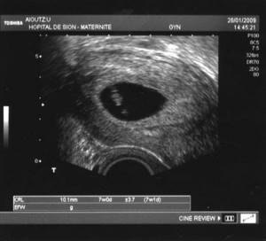 УЗИ на 3 недели беременности: фото, что видно?