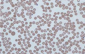 Анизоцитоз в общем анализе крови – что это такое?