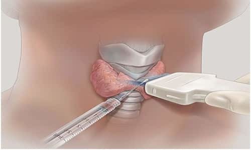 Биопсия щитовидной железы: как делают, показания к проведению, результаты