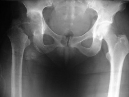 Рентген тазобедренного сустава: подготовка, нормы, как делают?