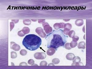 Атипичные мононуклеары в общем анализе крови – что это такое?