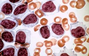 Лимфоциты повышены в крови у взрослого: что это значит, причины, что делать?