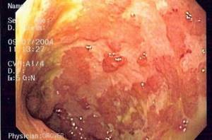 Колоноскопия кишечника: как проводится, для чего ее делают