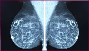 Когда делать маммографию: на какой день цикла лучше?