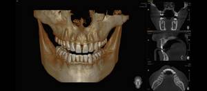 Компьютерная томография зубов (КТ): как проходит, для чего делают?